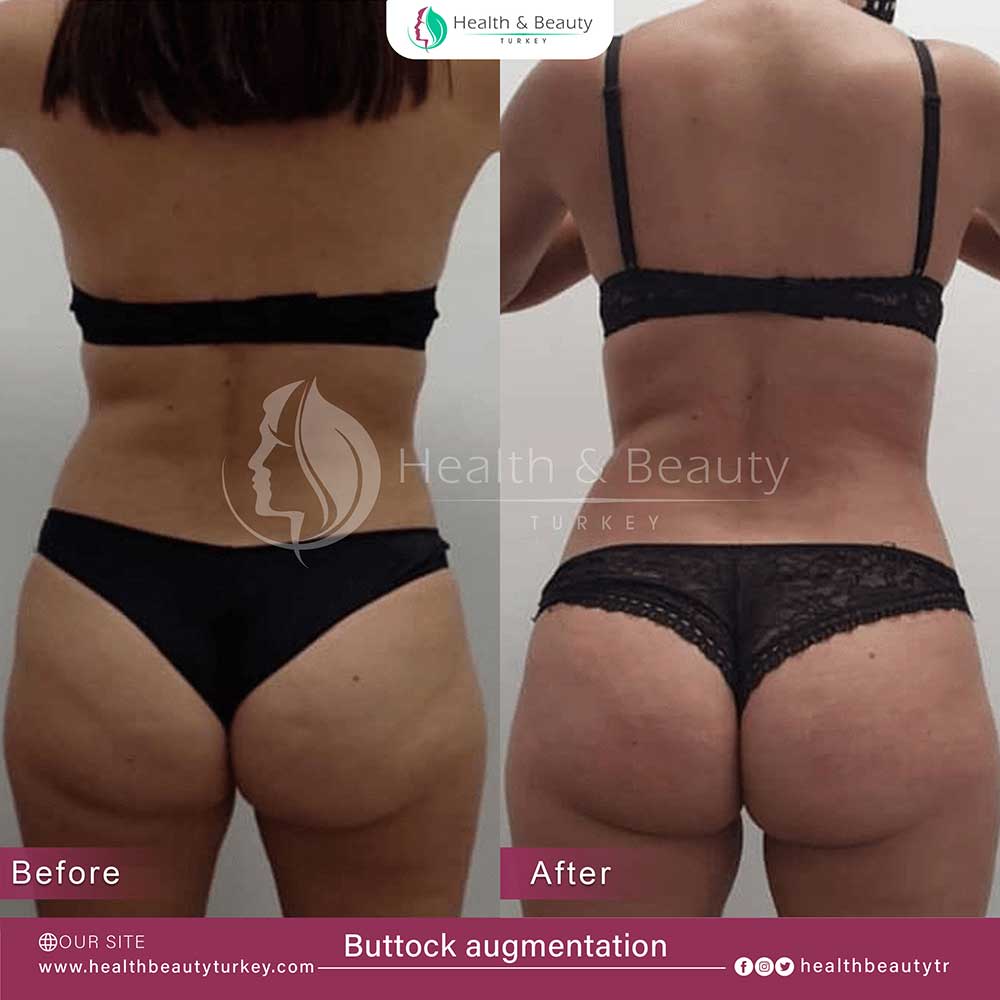 Buttock Augmentation page ar