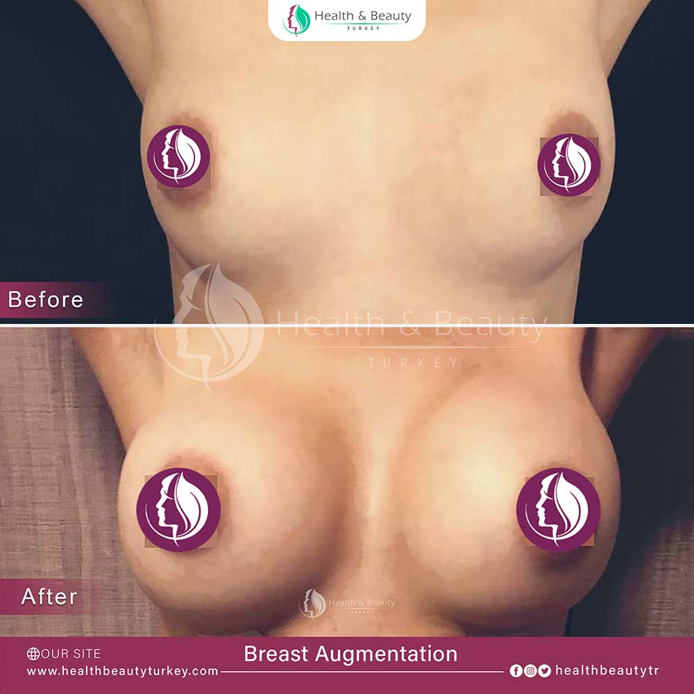 breast augmentation page fr