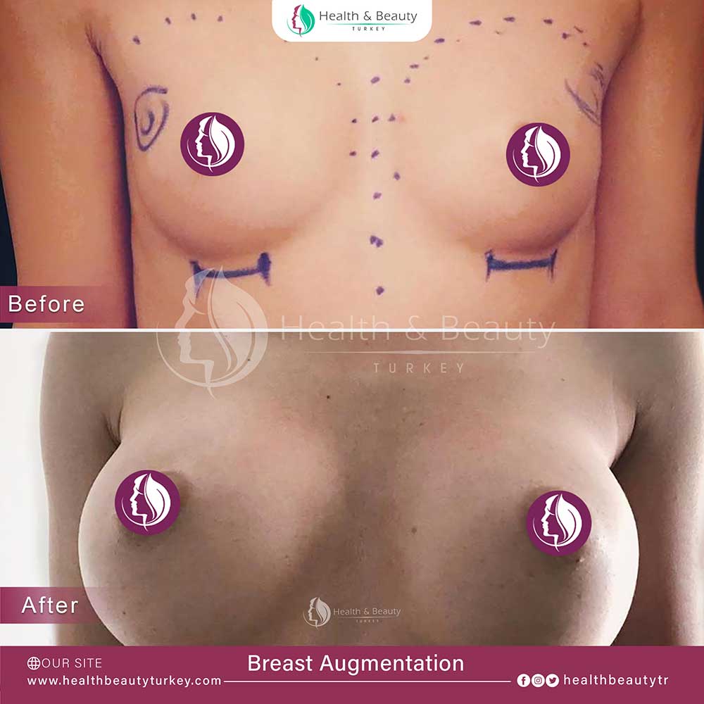breast augmentation page ar