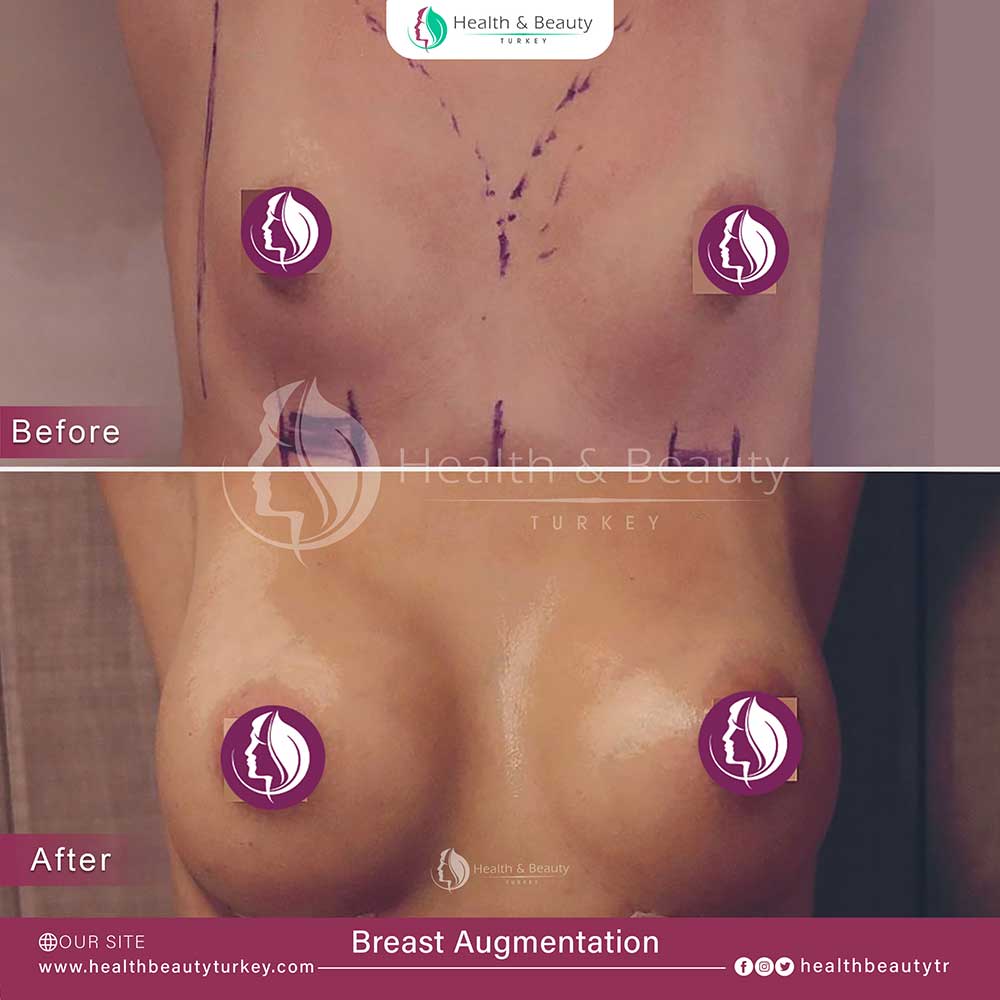 breast augmentation page en