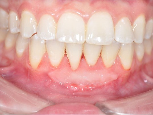 عملية زراعة اللثة لعلاج تلف الأسنان