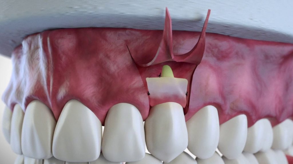 3 انواع ترقيع لزراعة اللثة في عيادة الأسنان تركيا