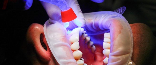 أفضل 6 تقنيات لتجميل الأسنان 