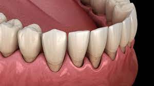 7 طرق علاج نزول اللثة على الأسنان بسبب التقويم