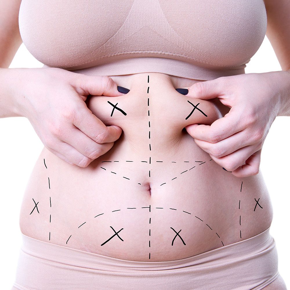 عملية شفط الدهون بالفيزر أفضل الخيارات للتخلص من الدهون