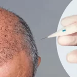 زراعة الشعر بتقنية أقلام تشوى DHI
