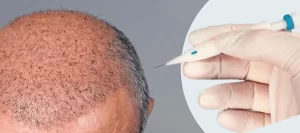 زراعة الشعر بتقنية أقلام تشوى DHI