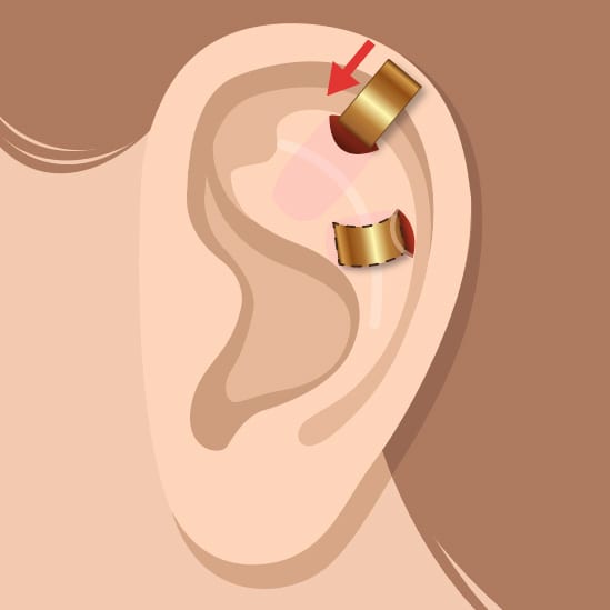 إجراءات تجميل الأذن الحديثة الطرق والأنواع 2022
