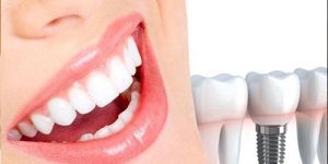 عملية زراعة الأسنان و الأبتسامة الطبيعية