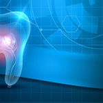 معالجة الأسنان بالليزر علاج بديل وسريع 2022