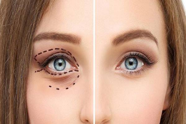 عملية تجميل العيون افضل 5 عمليات