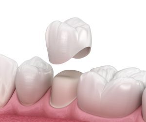 تيجان الأسنان وافضل 4 انواع