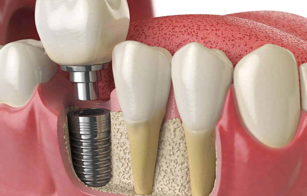 علاج الأسنان الاصطناعية
