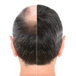 أنواع عمليات زراعة الشعر التجميلية