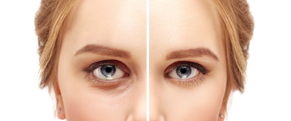 عملية إزالة أكياس العين افضل 5 خيرات