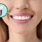عملية زراعة الأسنان الفورية