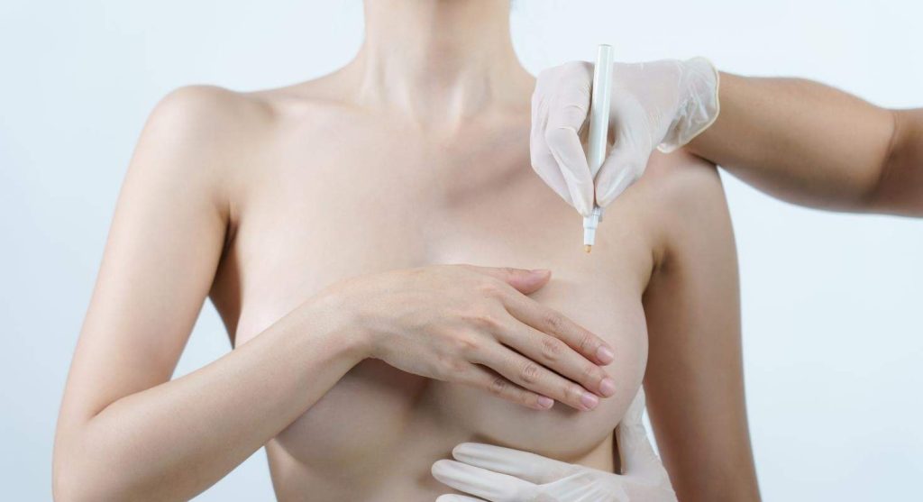 جراحة رفع الثدي أو شده