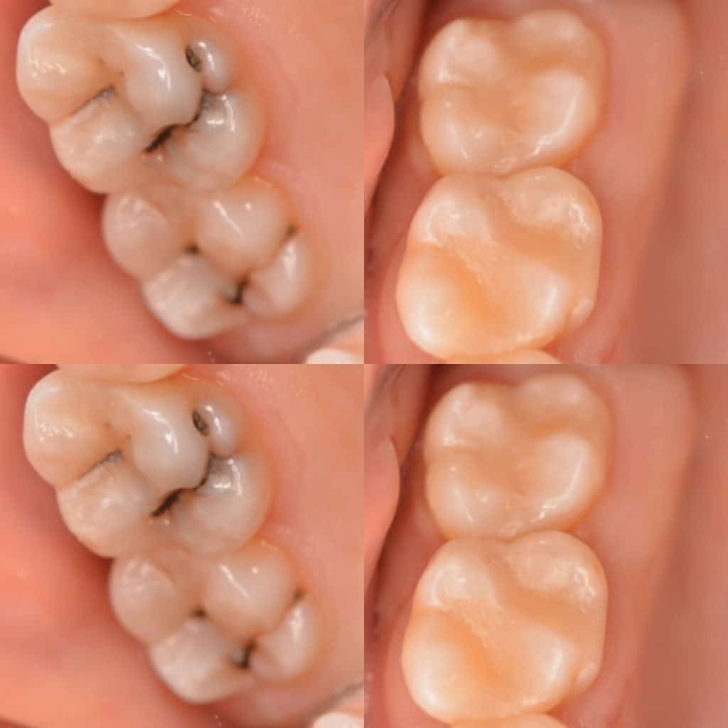 العلاج التحفظي للأسنان