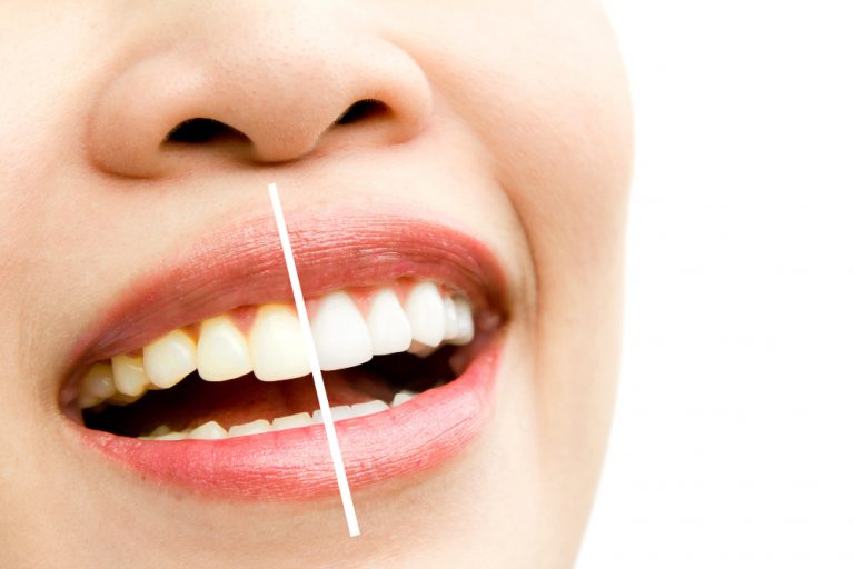 ما هي تقنية الزوم لتبيض الاسنان؟