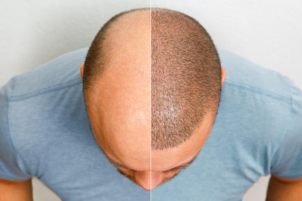 ما هي أسباب تساقط الشعر وطرق العلاج؟