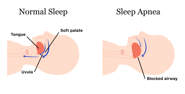 أسباب انقطاع التنفس أثناء النوم | الأعراض والعلاج