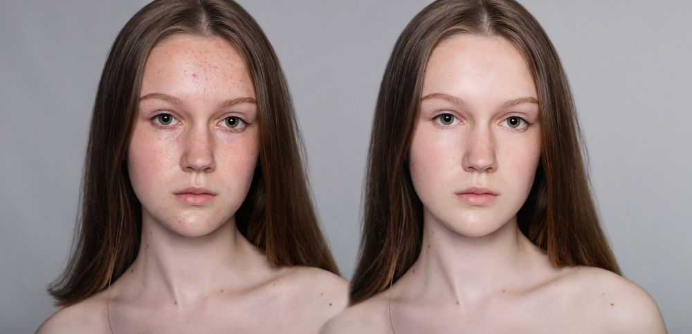 علاج ندوب الوجه | التخلص من حب الشباب