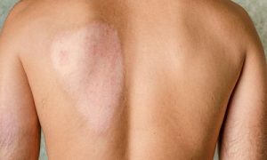 علاج التشوهات بعملية ترقيع الجلد