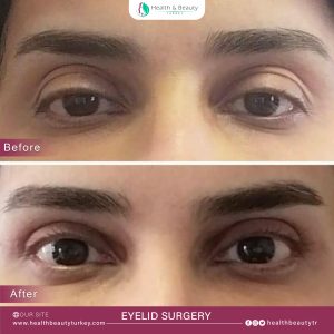 استعلم عن عمليات تجميل العيون في تركيا