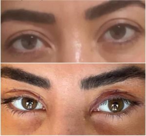 استعلم عن عمليات تجميل العيون في تركيا