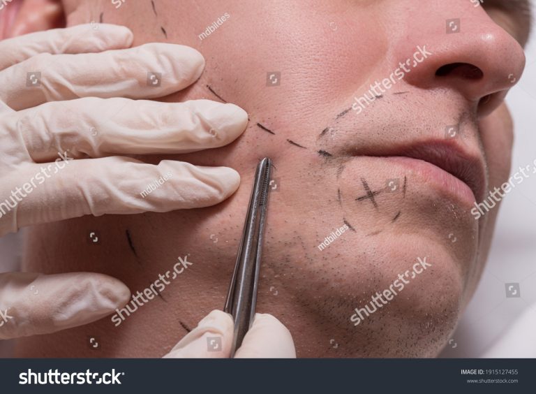 Beard Transplant