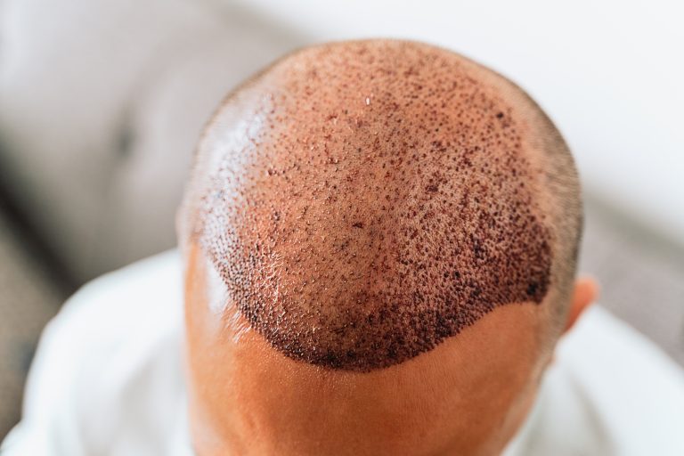 DHI Hair Transplant