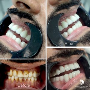 استعلم عن عمليات تجميل الأسنان في تركيا