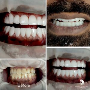 استعلم عن عمليات تجميل الأسنان في تركيا