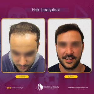 استعلم عن عمليات زراعة الشعر في تركيا