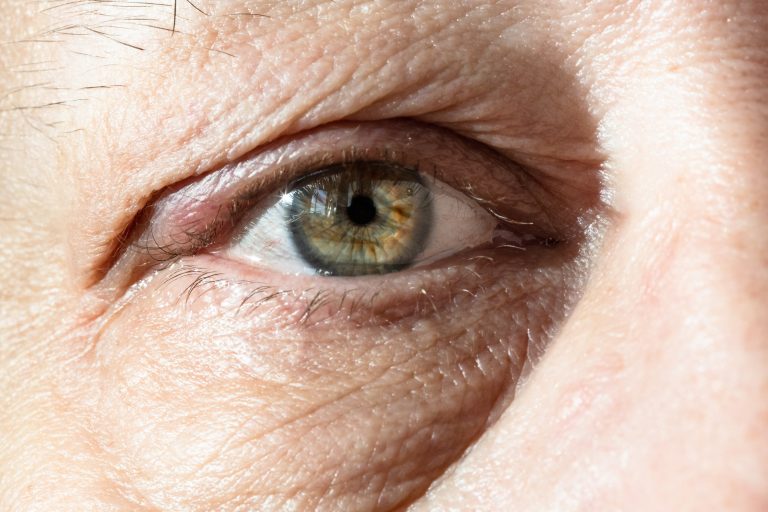 Droopy Eyelid Droopy Eyelid