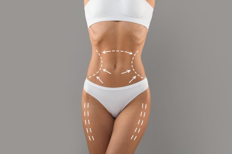Belt Lipectomy (Lower Body Lift) Belt Lipectomy (Lower Body Lift)