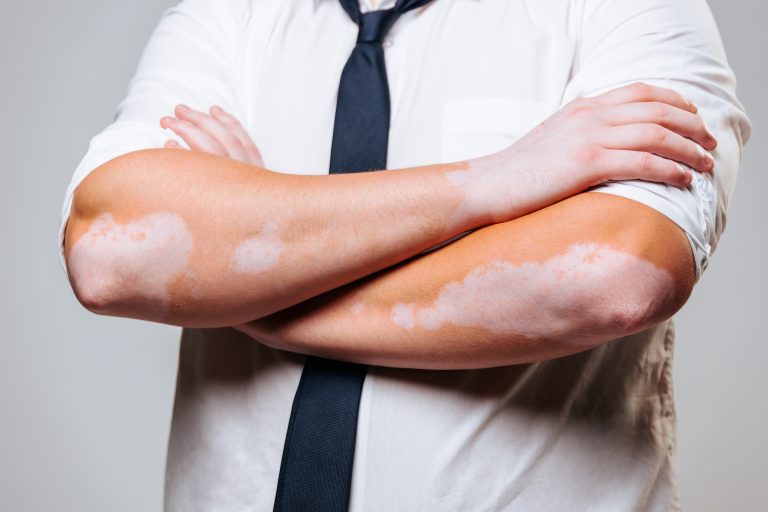 From Scar to Second Skin: How Skin Grafts Restore and Rebuild