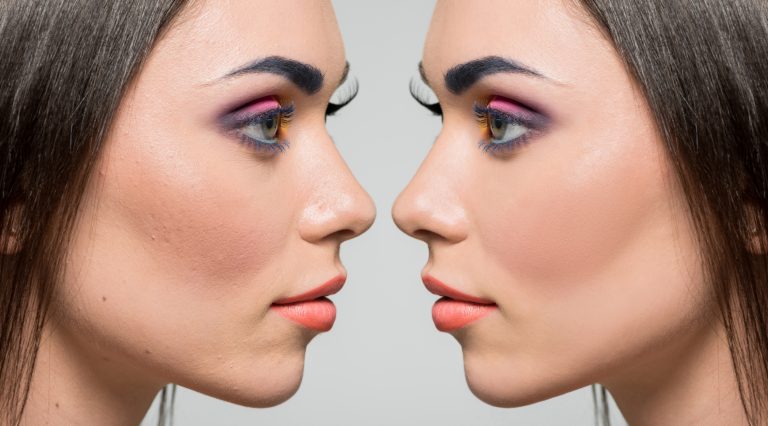 Beyond Makeup: A Permanent Solution to Flared Nostrils with Alarplasty