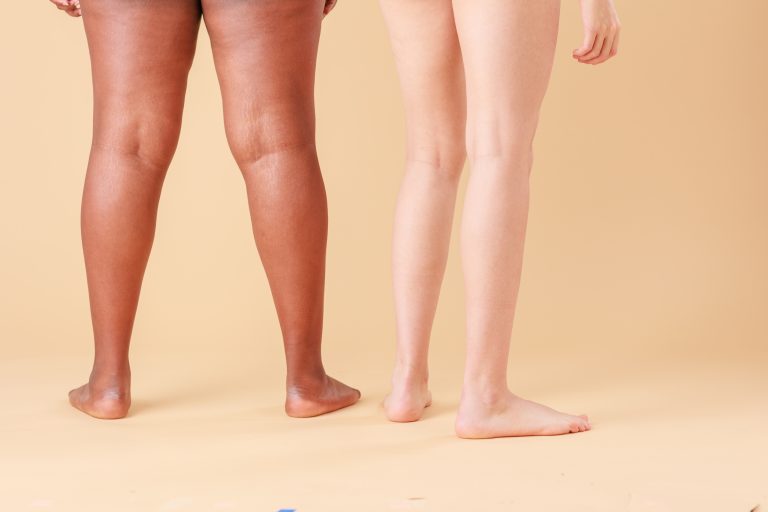 Managing Life with Lipedema and Reclaiming Your Movement